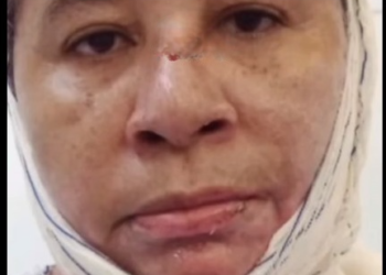 Mulher tem corpo queimado após atear fogo em lixo na cidade de José de Freitas